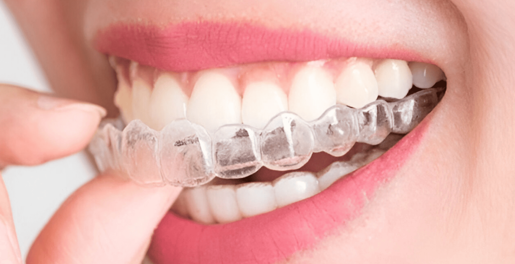 Aligner Transparan